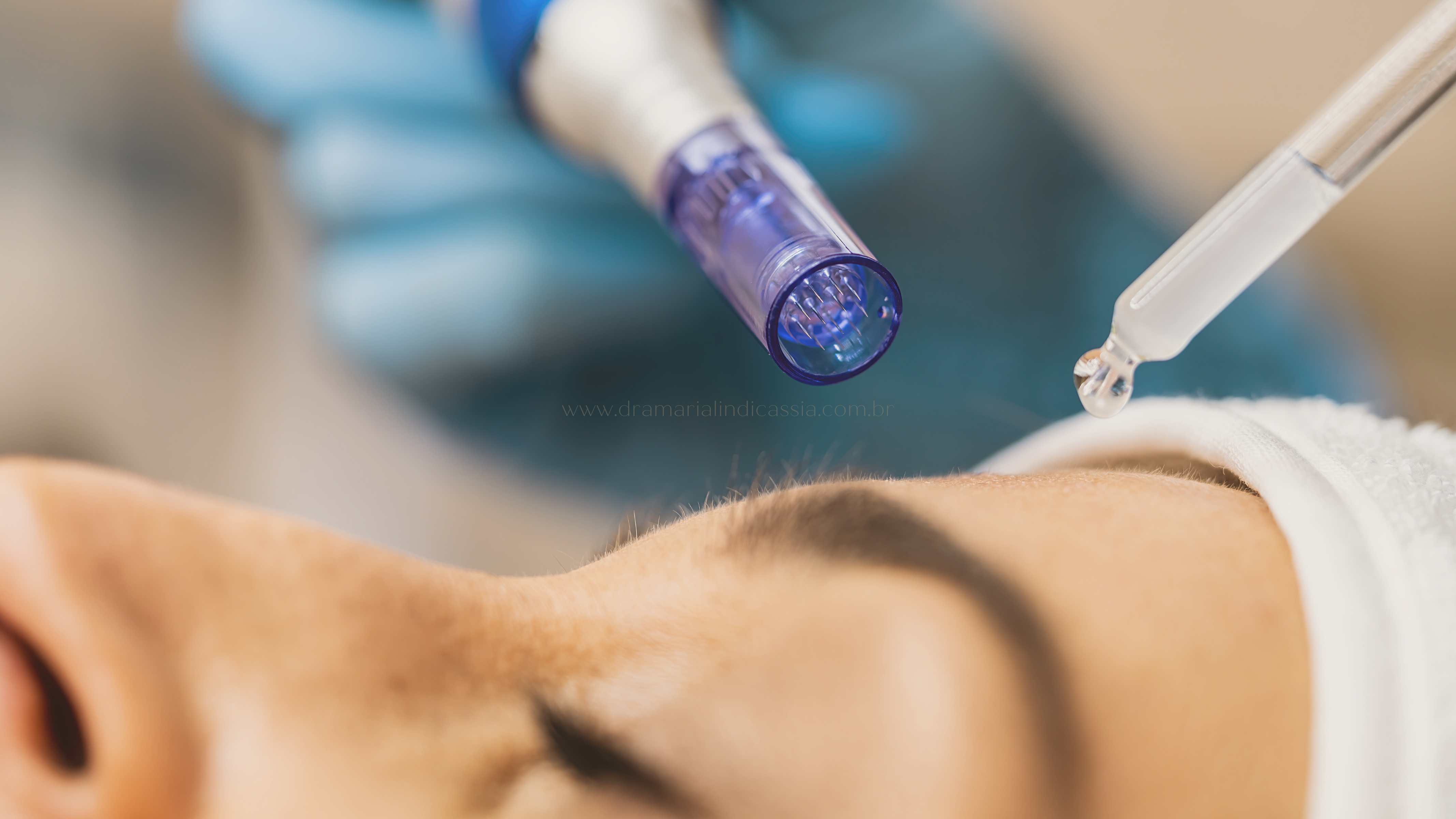 Dispositivo de microagulhamento estimulando a produção de colágeno. minimiza rugas e linhas de envelhecimento